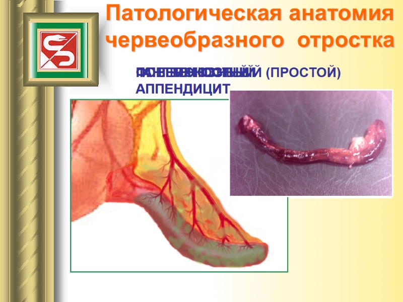 Патологическая анатомия червеобразного  отростка ПОВЕРХНОСТНЫЙ (ПРОСТОЙ)  АППЕНДИЦИТ ФЛЕГМОНОЗНЫЙ  АППЕНДИЦИТ ГАНГРЕНОЗНЫЙ 